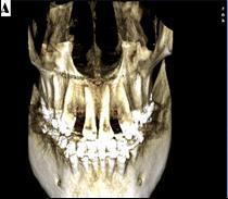 After measurements, a 14º root angulation was proved, with consecutive reduction of space between the central incisor and the canine, resulting in a lack of space for implant placement in the upper