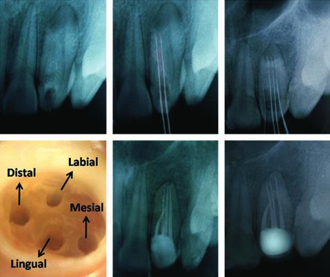 (a) (b) (c) (d) (e) (f) Figure 1 (a) A preoperative radiograph of tooth 12 showing the likelihood of root canal aberration.