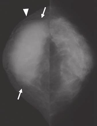 Mammography and Ultrasound During Pregnancy and Lactation A Fig. 3 33-year-old lactating woman presenting with inflammation and palpable mass.