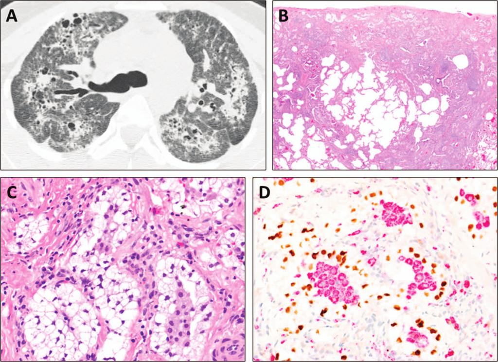 Figure 7. Hermansky-Pudlak syndrome. A, High-resolution computed tomography shows patchy bilateral irregular reticulation, traction bronchiectasis, and cysts.