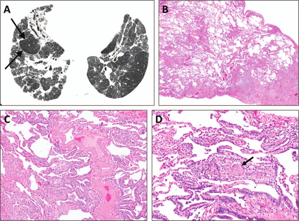 Figure 3. Chronic hypersensitivity pneumonitis. A, Fibrosis is present on high-resolution computed tomography, as evidenced by traction bronchiectasis and irregular reticulation.