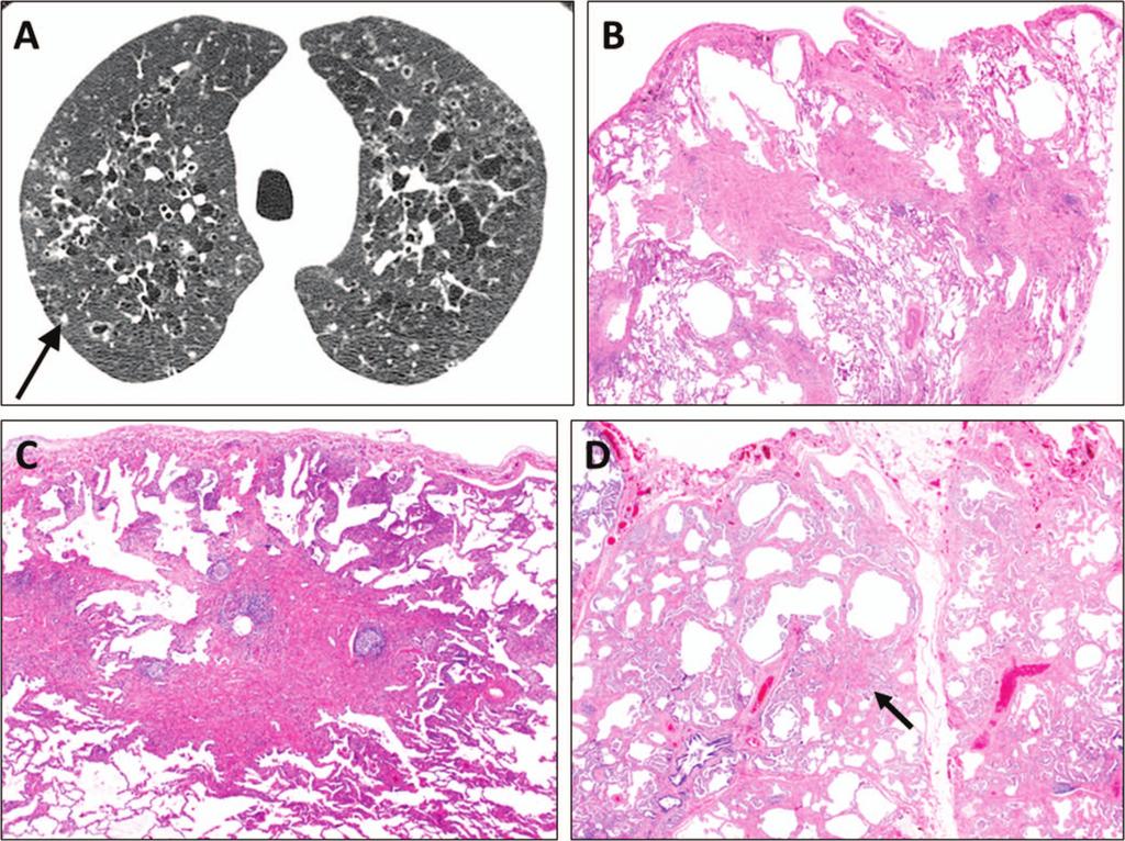 Figure 4. Advanced pulmonary Langerhans cell histiocytosis.