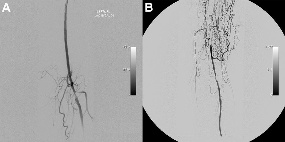 1000 Johnston et al JOURNAL OF VASCULAR SURGERY October 2012 Fig 1. Angiographic images of representative collaterals.