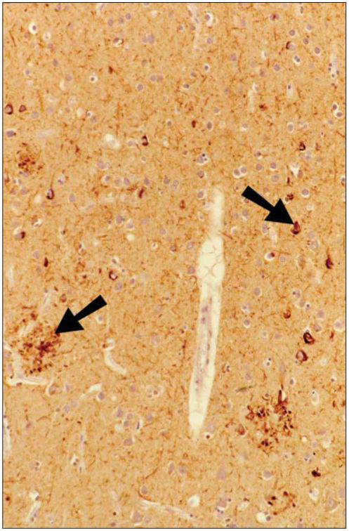 Berlau et al. Page 6 Figure 1. The case subject demonstrated neocortical neuropathologic features of Alzheimer disease.