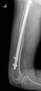 (D) Radiographs showing a right femur shaft insufficiency fracture at 3 days after ER visit.