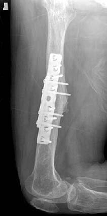 (E, F) Radiographs showing a contralateral side insufficiency fracture without pseudomotion that was treated
