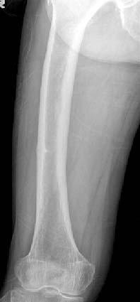 Regarding the fixation of the femur, intramedullary nails were used in 9 patients (7 patients with unilateral and