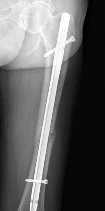 caused by fracture were not detected, in all cases, weight bearing was reduced by the use of crutches, the