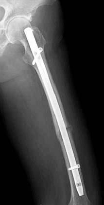 In all patients who underwent surgery, bone union as well as fixation stability were assessed by taking plain