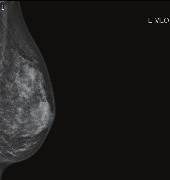 naključno izbrani. Standardna mamografija je sestavljena iz štirih mamogramov, in sicer: dva mamograma od zgoraj navzdol (cranio-caudalno oz.