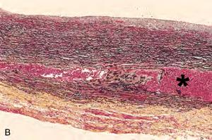 Histologic view of an aortic dissection demonstrating an intramural haematoma (asterisk).