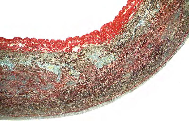 Changes of cystic medial degeneration in the aorta in Marfan s syndrome. In this special stain, the elastic tissue is black and collagen red.