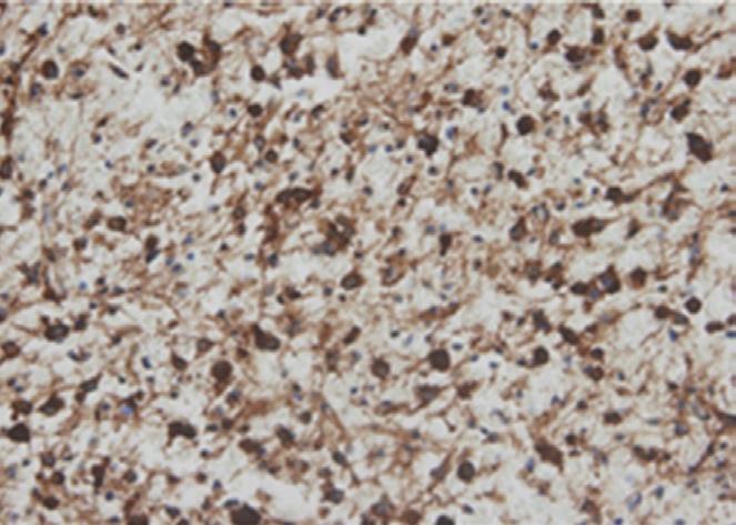 544 Lee KS, et al. blastoma patients was 53.8 years. The mean age of EGFR(+)/ p53( ) immunohistochemically primary glioblastoma patients was 11.