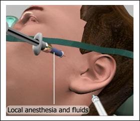 In this procedure, the surgeon injects local anesthesia and fluids