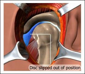 Disc Repositioning: This is done in conditions of disc displacement which creates a popping