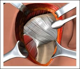 Discectomy: This is done when the disc is damaged.