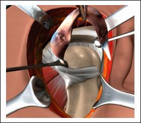 incision and the disc is removed. (Fig. 24) (Refer fig.