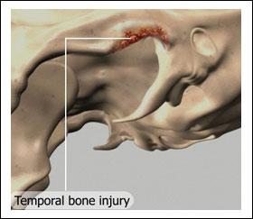 When the ends of the jawbone are damaged (condylar injury), they can also be