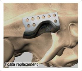 33) Total joint replacement: The ball and joint both are replaced with metal