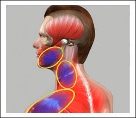 common form of the disease and involves discomfort or pain in the muscles of the jaw, neck