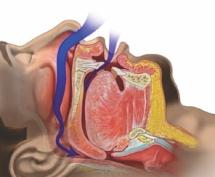 Sleep apnea is characterised by frequent pauses of breathing during sleep. Obstructive sleep apnea (OSA) is caused by blocked airflow during sleep from narrowing and closure of the upper airway.