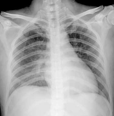 Postpartum pulmonary edema 159 Fig.