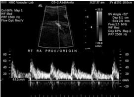 RENAL ARTERY Normal Waveforms Waveform Curiosities: Early and