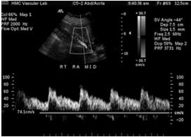 Renal-aortic ratio (RAR) = PSV renal /PSV aorta PSV and