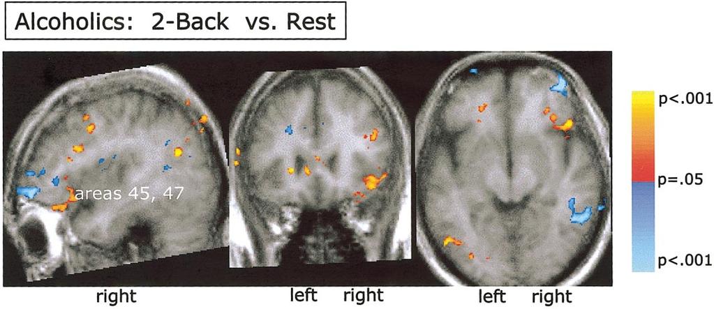 16 PFEFFERBAUM ET AL. FIG. 1. Significant regions of activation in the 2-back vs match-to-center contrast observed in controls.