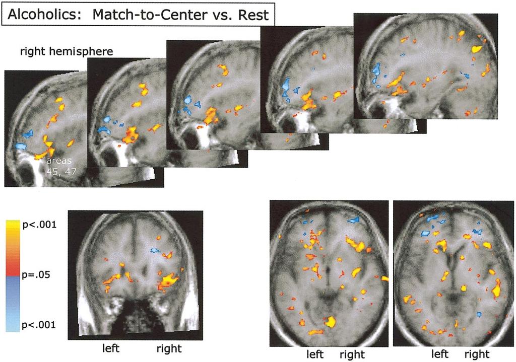 REORGANIZED PREFRONTAL ACTIVATION IN ALCOHOLICS 17 FIG. 3. Significant regions of activation in the match-to-center vs rest contrast observed in alcoholics.