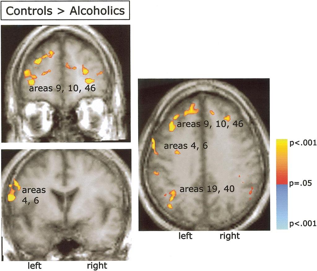 REORGANIZED PREFRONTAL ACTIVATION IN ALCOHOLICS 19 FIG. 5. Significant regions of group differences in activation in the 2-back vs rest contrast.