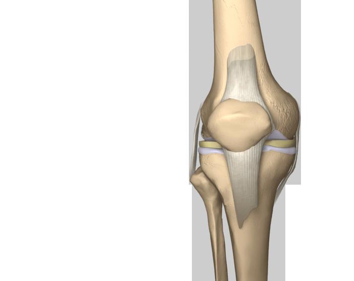 PARTIAL KNEE REPLACEMENT A partial knee replacement removes damaged cartilage from the knee and replaces it with prosthetic implants.