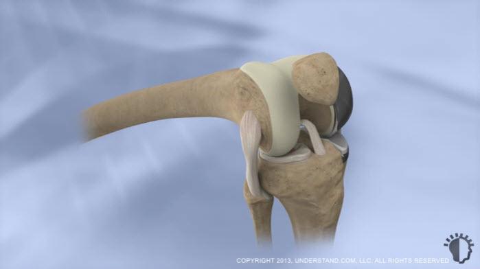 Muscle and fatty tissue are carefully moved aside, and the patella is shifted to one side to provide access to the femur and tibia in the affected compartment.