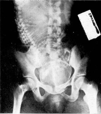 This shows that the back has turned a little forwards and become less bent. FIG. 4. The occiput has descended below the pubis.