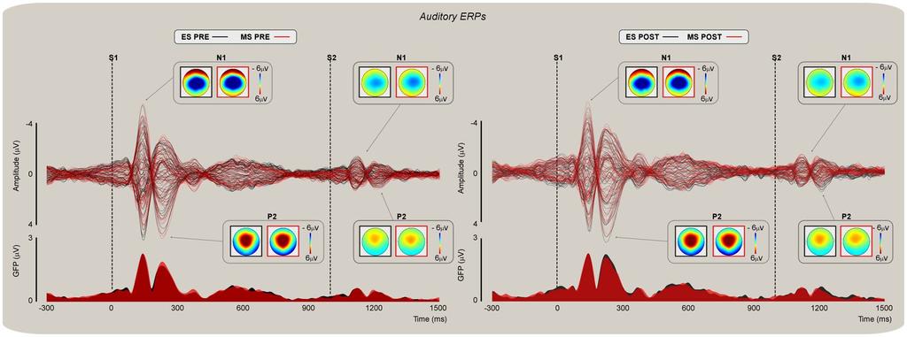 Figure 4. Auditory evoked potentials (AEPs).