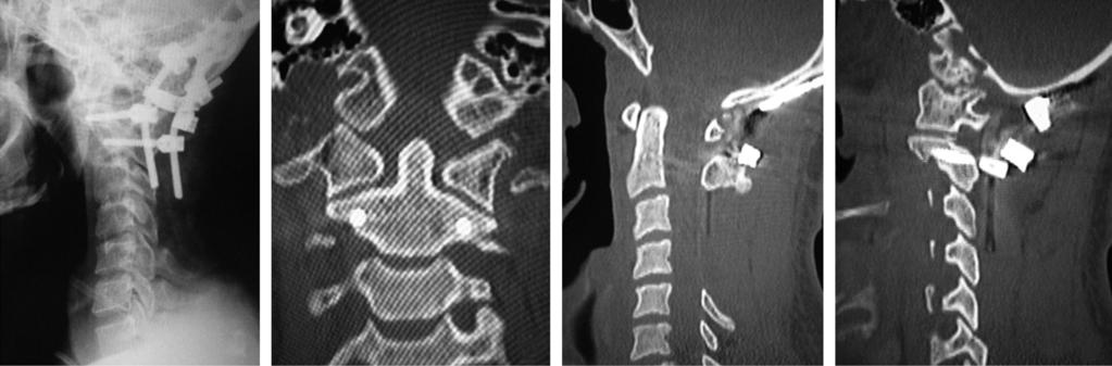 Coronal (B) and sagittal (C, D) computed tomography images showing a reduction of the atlanto-occipital dislocation. A B C D E Fig. 4. Indices of atlanto-occipital dislocation in the present case.