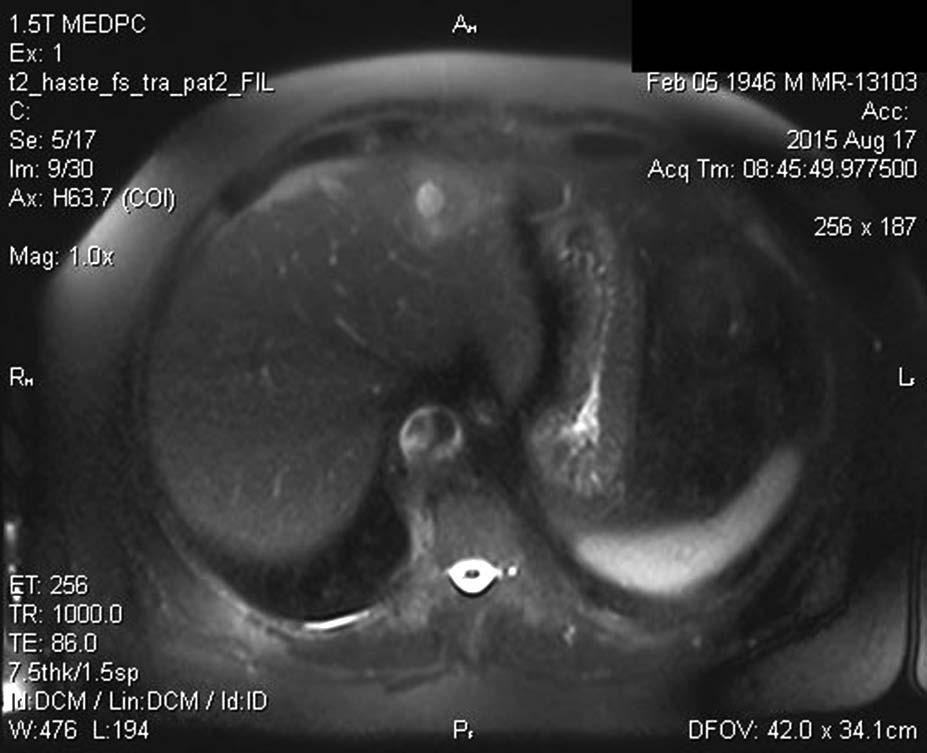 50 Figure 3. MRI scan: Axial T2 weighted haste image. A well demarcated cystic lesion surrounded by inhomogeneous liver tissue in the left liver lobe Slika 3. Magentno rezonantni pregled.