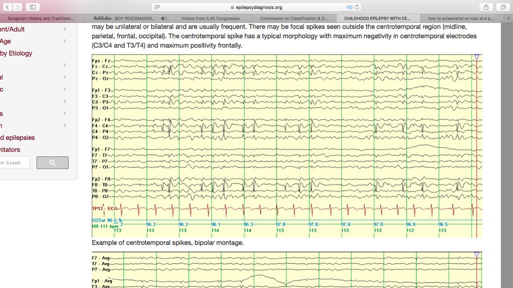 19 BENIGN CHILDHOOD EPILEPSY WITH CENTROTEMPORAL SPIKES Benign focal epilepsy of childhood(bfec), Rolandic epilepsy (BRE) Clinical: age onset 3-14 y/o(peak 8-9), hemifacial seizures that may