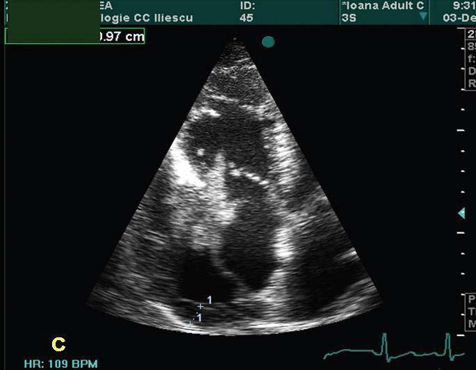 Fig. 2 The same apical four-chamber plan. Ventricular systole. The tumor is inside the right ventricular cavity passing through the semiclosed tricuspid cusps. Fig.