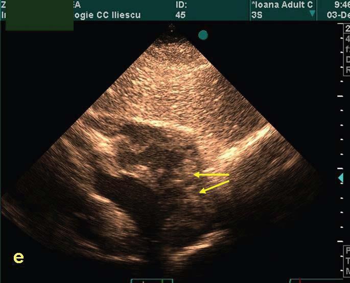 Leiomyosarcoma of the inferior vena cava extanding into the right cardiac chambers Fig. 4 Apical four-chamber view. Diastole.