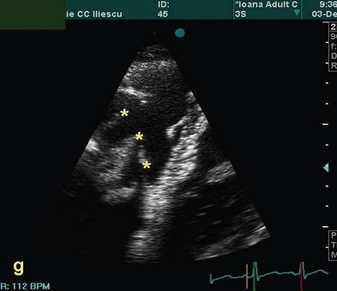 According to the cardiac site, there are right heart angiosarcomas (presented case), left heart angiosarcomas and pulmonary artery angiosarcomas [1,2].