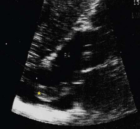 Due to difficult images recording, we only present one echocardiographic shot, recorded at the admission. adipose tissue.