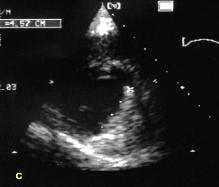 Fig.8 Parasternal short axis recording of the left ventricular cavity.