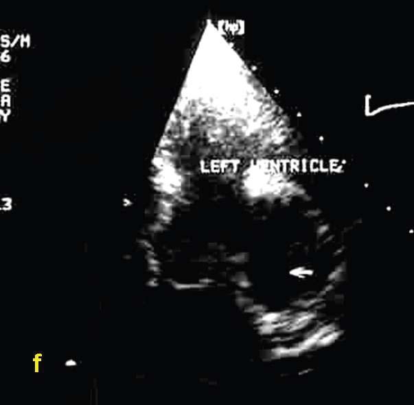 Located in the intrapericardial space, along the left border of the heart, towards the base of the