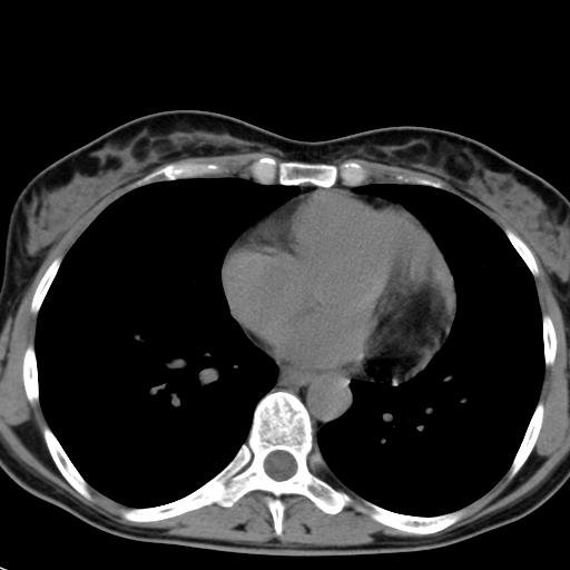 An ovoid echofree space (arrow)- the pericardial cavity after the tumor was removed. Fig.
