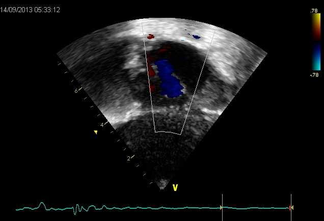 Atrial Shunting Right-to-left atrial shunting reflects right atrial filling (diastolic) pressure or ventricular filling more than right ventricular systolic pressures.