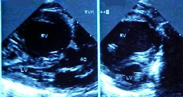 the LV is small, and another structure - the pulmonary venous