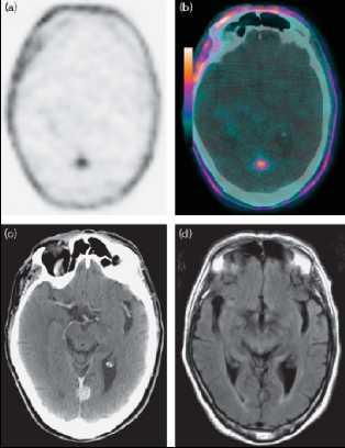 70-yr-old, GS 8, T1 N1) 26 months after RP PSA 2 to 7 ng/ml / 9 mo lesion 1.5 cm intense CE MRI 3.