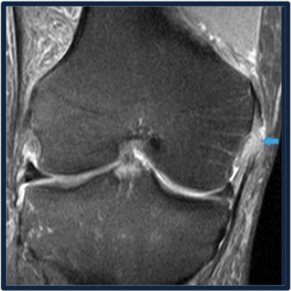 Fig. 12: Coronal PDFS image shows grade III TEAR OF MCL towards femoral attachment site.