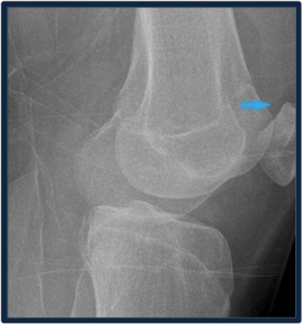 Fig. 9: Lateral radiograph shows